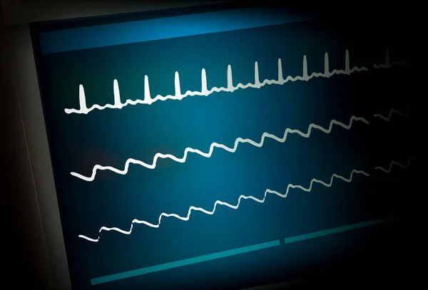 Monitor Del Paciente Que Muestra Signos Vitales Ecg Ekg — Foto de Stock