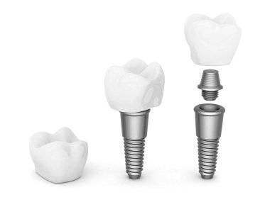 Diş implantları