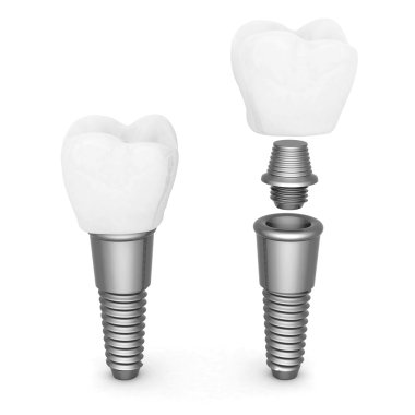 Diş implantları