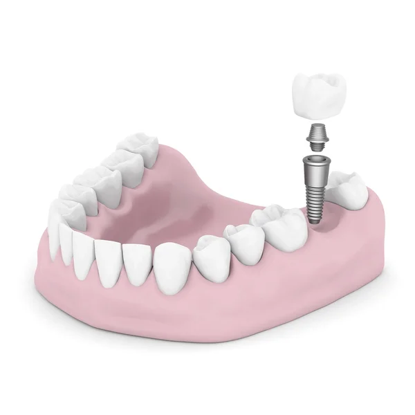 Diş implantları — Stok fotoğraf