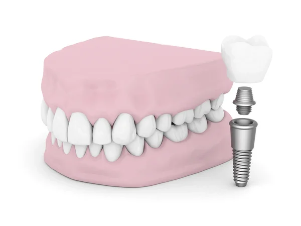 Tandheelkundige implantaten — Stockfoto