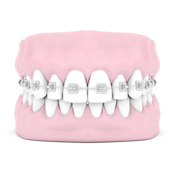 Dental braces — Stock Photo, Image