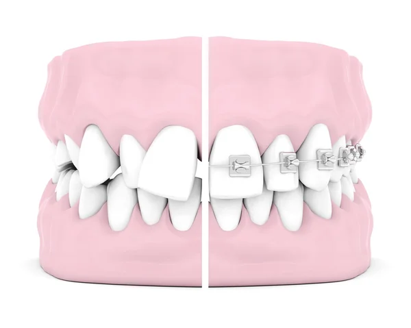 Bretelle dentali Fotografia Stock
