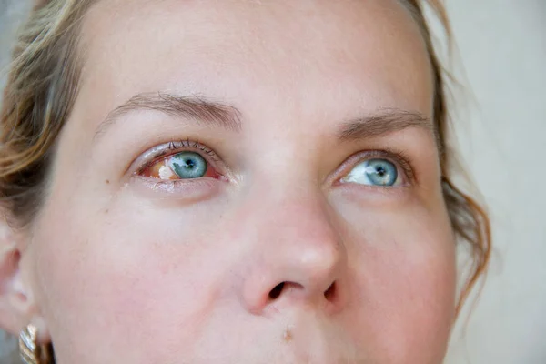 Kadının sağ gözü keratit olmuş. Gözkürenin lifli tuniği kırmızıdır. Gözler sulu. - Yakın çekim. Genç bir kadının portresi