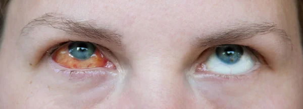 Правый Глаз Женщины Болен Кератитом Фиброзная Туника Глазного Яблока Красная — стоковое фото