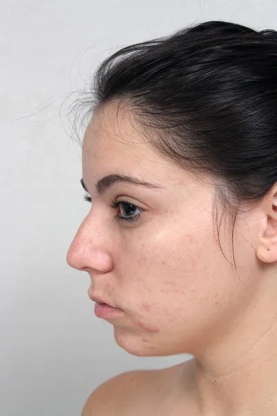 Menina com acne (2 ) — Fotografia de Stock