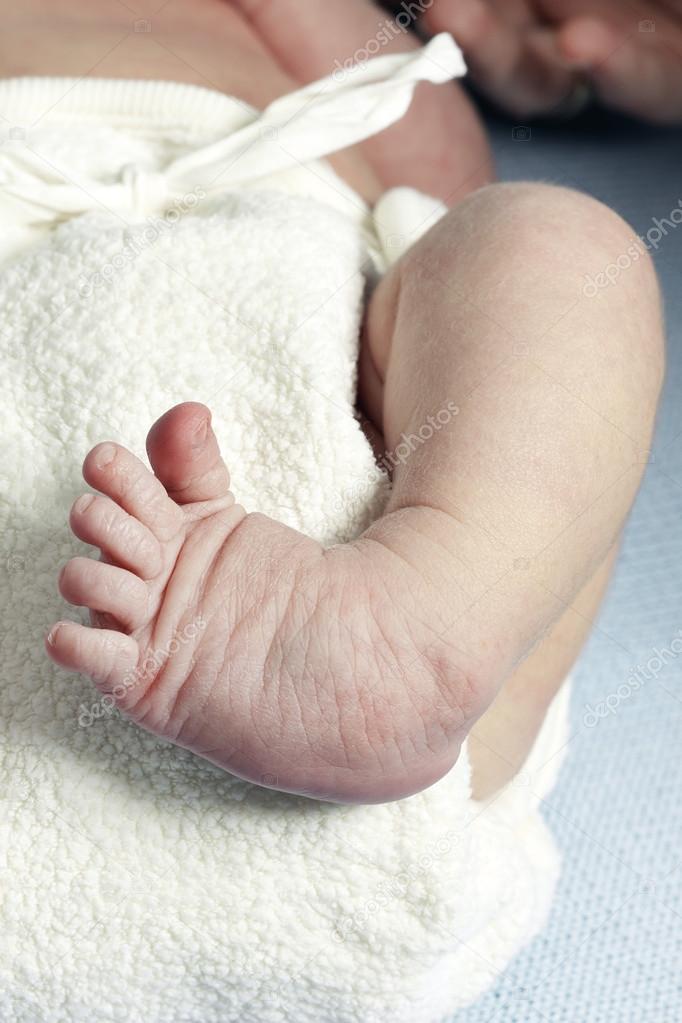 Clubfoot closeup of a newborn