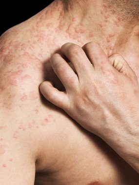 Man Scratching Allergic Skin clipart
