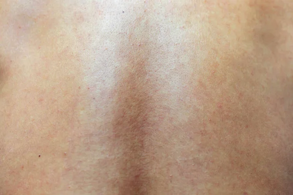 Woman Problematic Skin Pore Dark Spots — Stockfoto