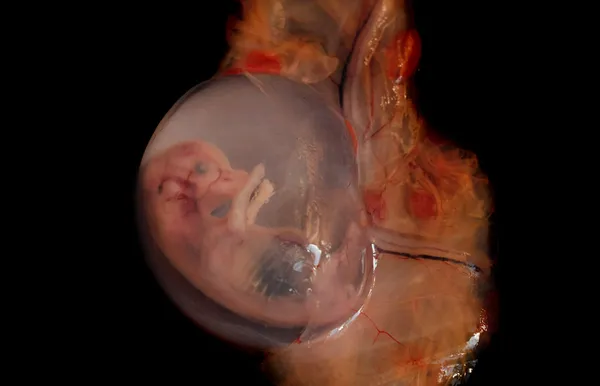 중단 된 태아 — 스톡 사진