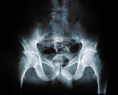 insan sonunu hip coxal esrar x-ray