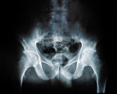 X-ray of a human break hip coxal joint clipart