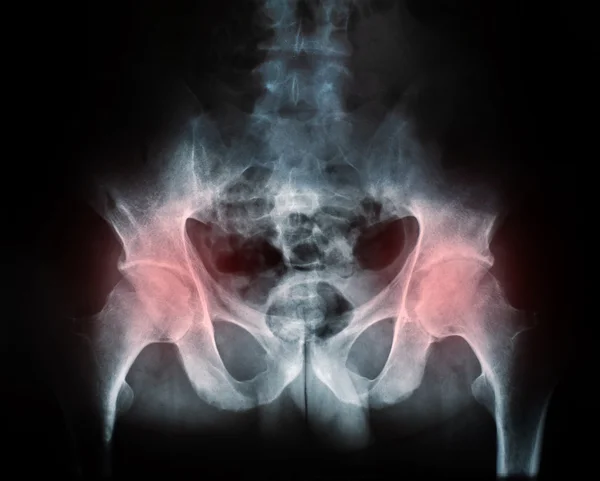 Raggi X di un'articolazione coxale dell'anca di rottura umana — Foto Stock