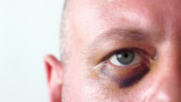 Un hombre con un ojo morado — Vídeos de Stock