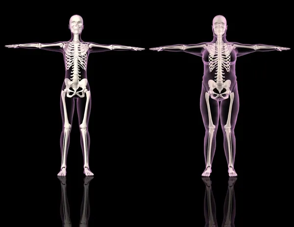 Medical female skeletons one slim and one overweight — Stockfoto