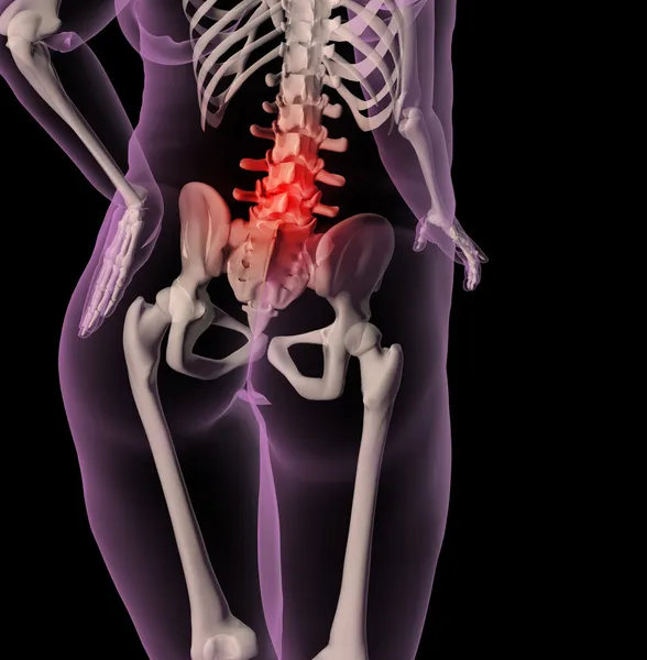 Överviktig kvinna skelett med ryggsmärtor — Stockfoto