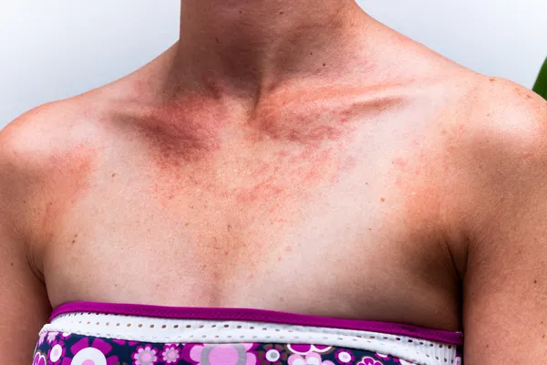 Загорелая женская кожа с аллергией на солнце — стоковое фото