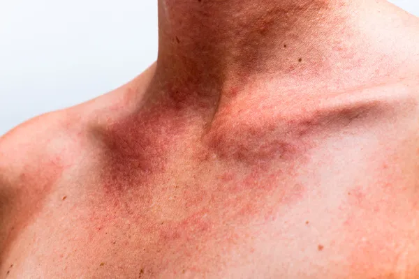 Аллергия на солнце — стоковое фото