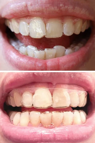 Transparent aligners to straighten crooked teeth - worn before and after a few months of treatment