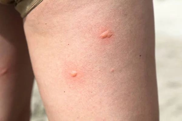 Picadura Mosquito Piel Irritada Pierna Mujer Muslo —  Fotos de Stock