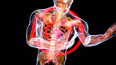 Bir kalp krizinin üç boyutlu çizimi