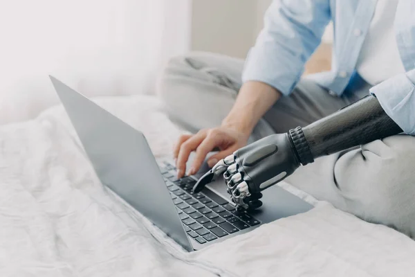 Bionic prosthesis and healthy arm. Hands of disabled girl are typing on keyboard of laptop. Handicapped european woman with artificial limb working on pc at home. Bionic fingers on buttons.