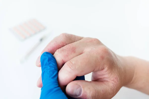 Bir Adam Ellerinde Kızarıklık Olduğunu Doktora Gösterir Kaşınan Cildin Nedeni — Stok fotoğraf