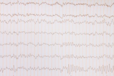 EKG arka planı