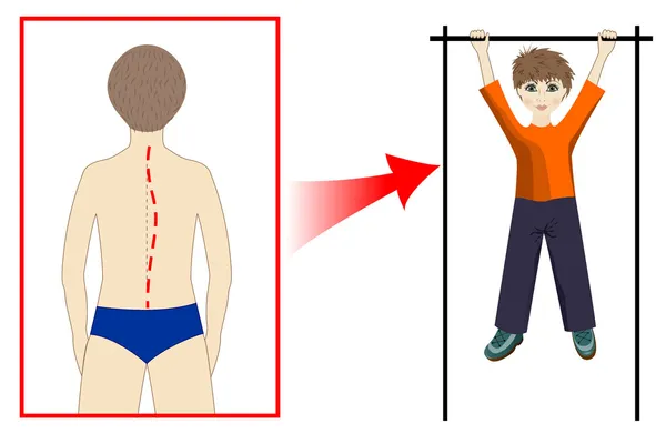 Prophylaxis of spinal curvature — Stock Vector