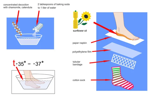 Períodos procedimientos cosméticos y prevención de tacones agrietados — Vector de stock