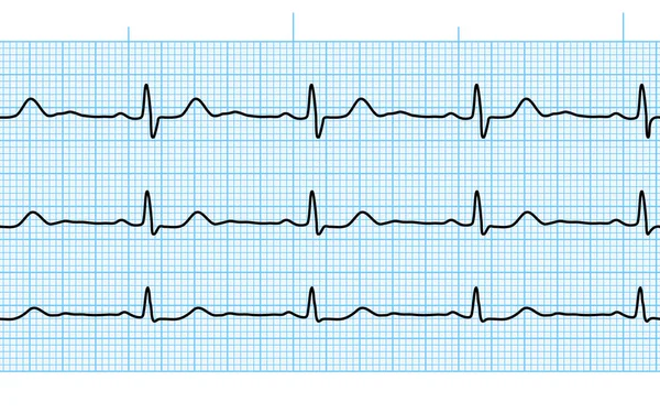 Сердцебиение ЭКГ или ЭКГ бесшовная черная линия на голубой бумаге — стоковый вектор