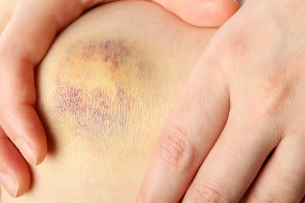 Pohmožděné koleno ženy — Stock fotografie