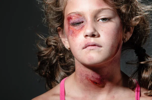 Τραυματίες παιδί — Φωτογραφία Αρχείου