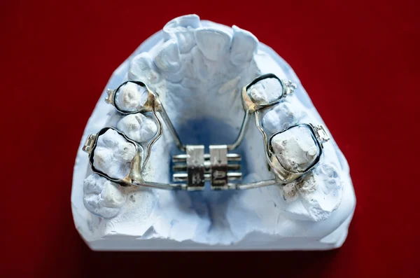 Moldes dentales — Foto de Stock