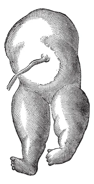 図 36。acephaly 頭部障害の型ビンテージ彫刻 — ストックベクタ