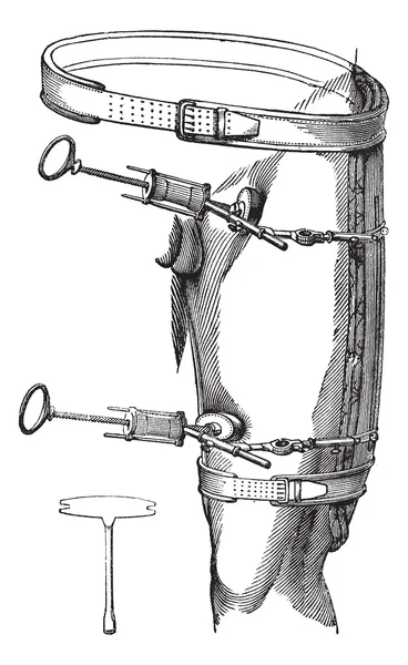 Fig. 89. been compressie van de aorta met behulp van een been compressie te — Stockvector