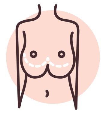 Göğüs küçültme ameliyatı, illüstrasyon, beyaz arka planda vektör.