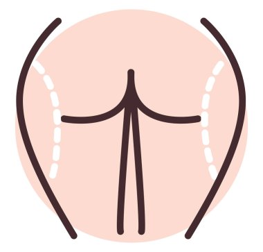 Kalça inceltme ameliyatı, illüstrasyon, beyaz arkaplanda vektör.