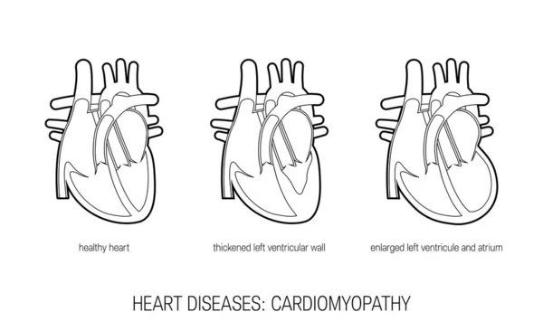 Kalp hastalıkları konsepti düz stil, vektör — Stok Vektör