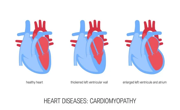 Concepto de enfermedades del corazón en estilo plano, vector — Vector de stock