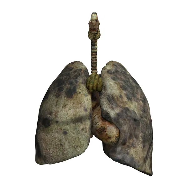 Lungen von Rauchern — Stockfoto
