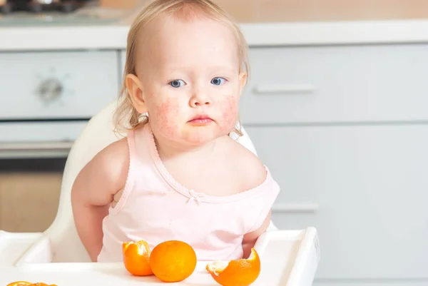 Cute child toddler with food allergy on face. High quality photo