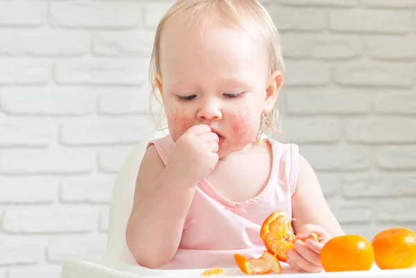 Cute child toddler with food allergy on face. High quality photo
