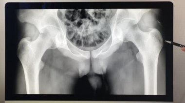 Doktor radyoloji uzmanı kalça eklemini gösteriyor. Coxofemoral kalça ekleminin X ışını.