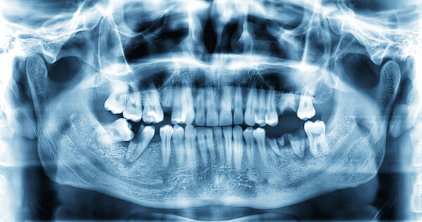 Panoramic dental x-ray image of teeth.