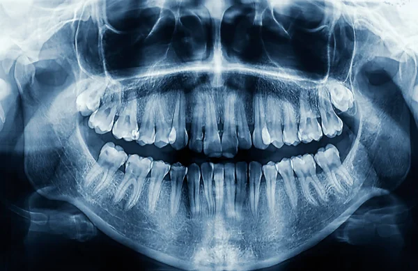 Panoramic Dental Tooth Ray Year Old Teenage Girl — Stock Photo, Image