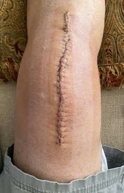 Human knee with staples after a knee replacement surgery on a pillow for elevation.