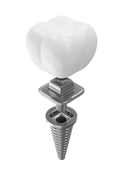 Implante dentário isolado sobre fundo branco — Fotografia de Stock