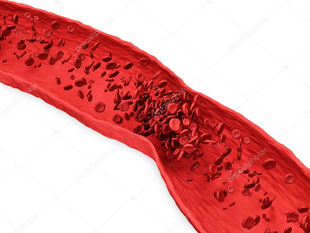 Digital Illustration of a Blood Clot in Vein isolated on white background