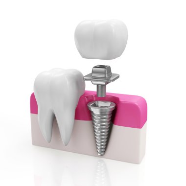 diş sağlığı ve diş implant